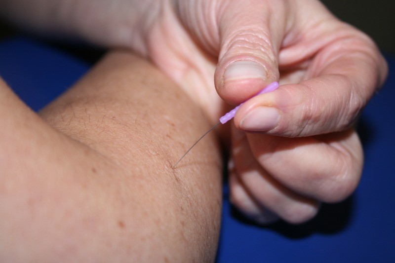 dry-needling-2 dry-needling-2