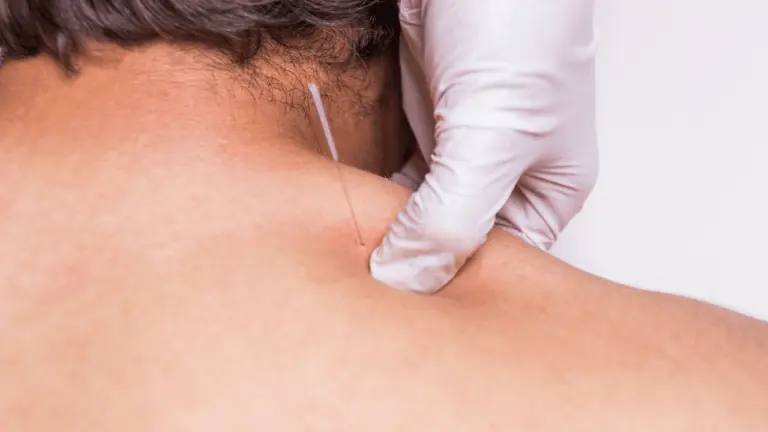 dry-needling-1 dry-needling-1